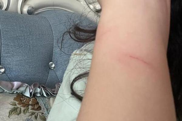 女人梦到被猫抓伤手